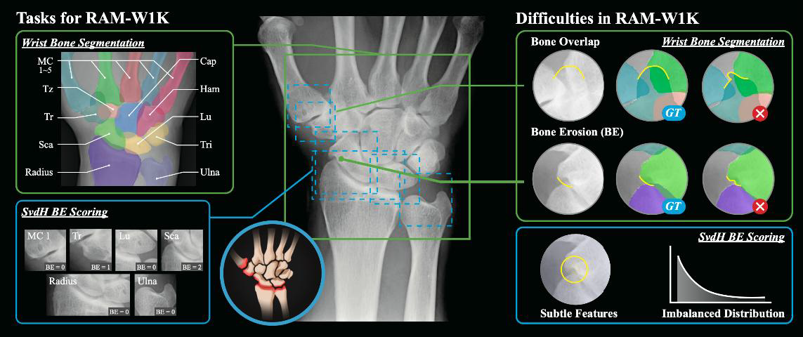 リウマチ画像解析の学習データとAIベンチマークを公開～1,048手のX線データセットがリウマチ診断支援の進化を加速～