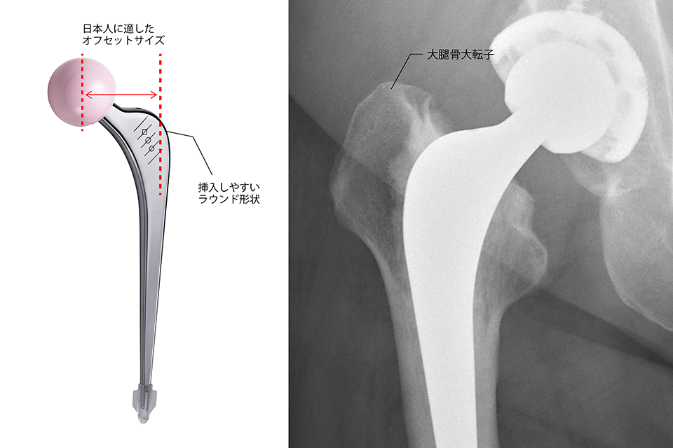 北海道大学と帝人ナカシマメディカル株式会社とで共同開発したVLIAN（ブライアン）ステム（左）と設置後のレントゲン写真（右）。日本人に最適なオフセットサイズで大腿骨大転子の骨切除を最小限にして挿入可能な形状になっている