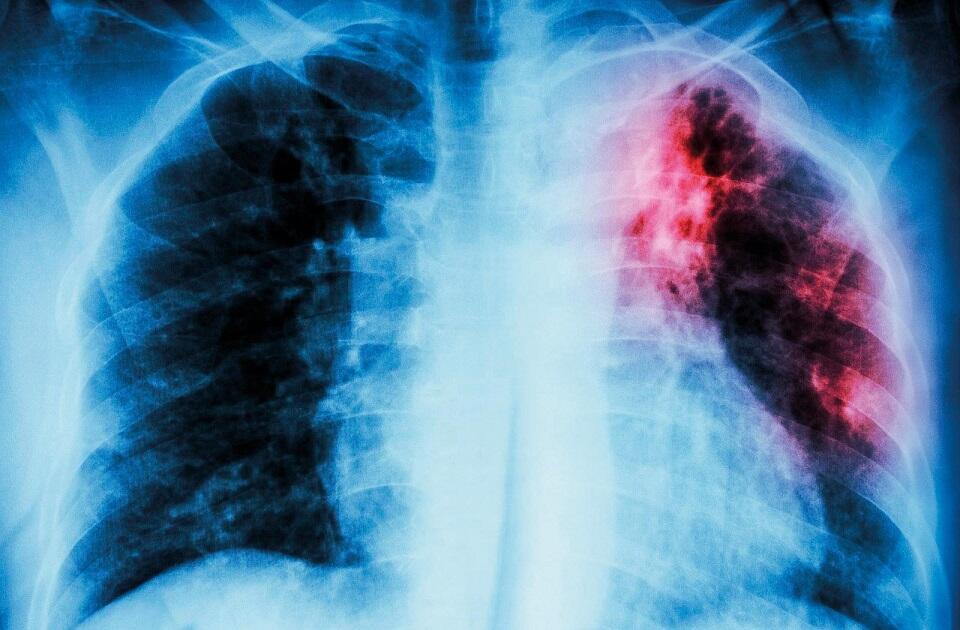 肺結核患者の胸部X線写真：結核菌感染により間質性浸潤が肺の左上に見られる（©️iStock）
